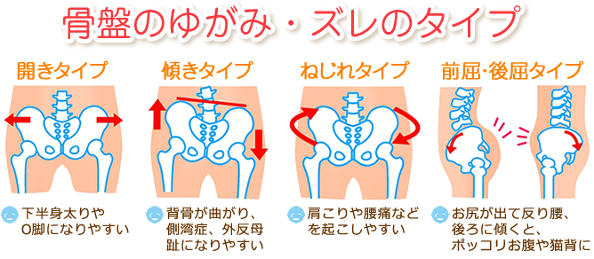骨盤きれい整骨