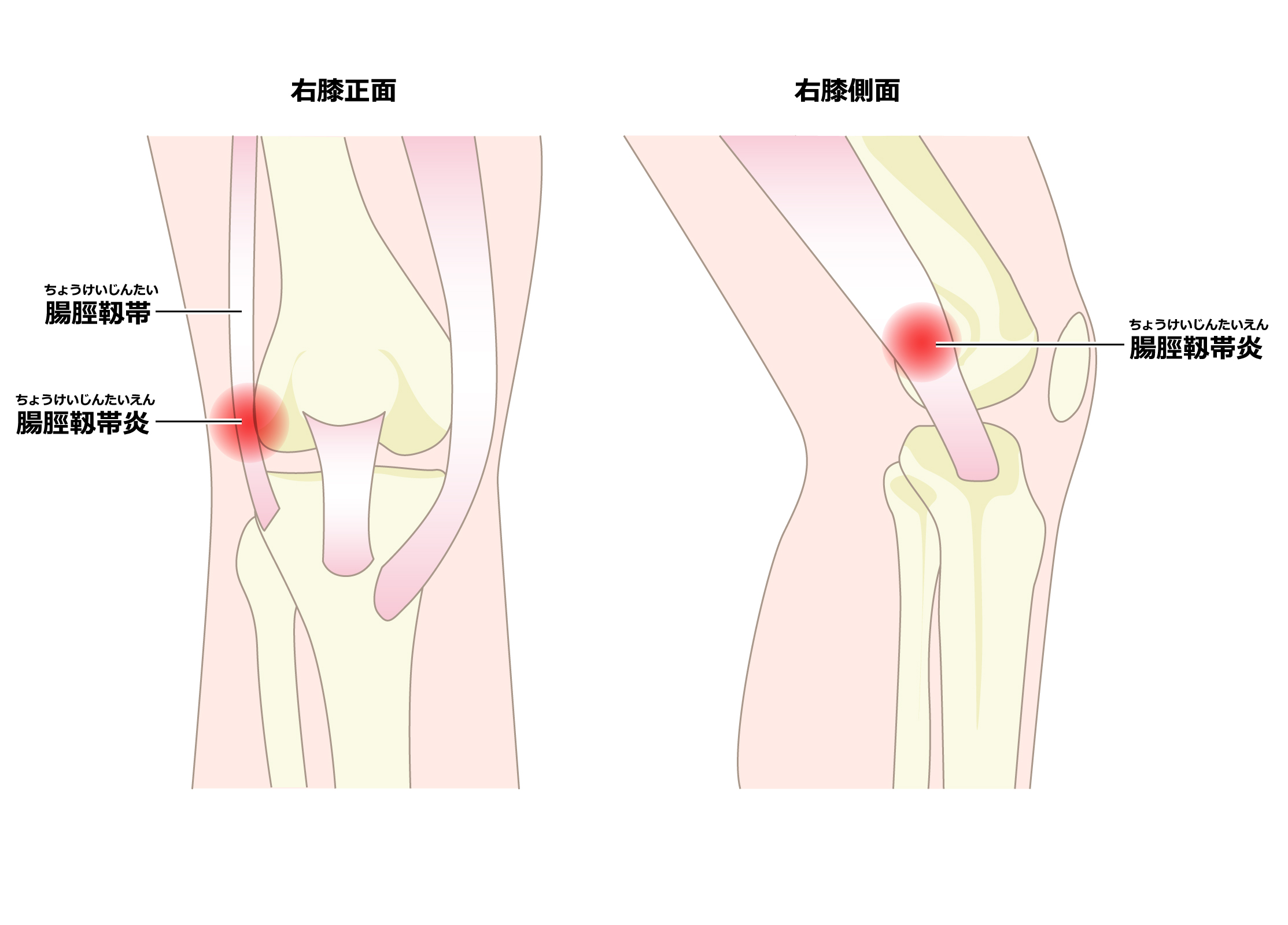 腸脛靱帯炎・ランナー膝